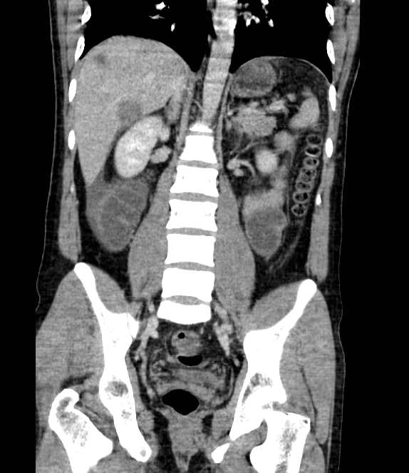 Bowel obstruction from colon carcinoma (Radiopaedia 22995-23028 C 47).jpg