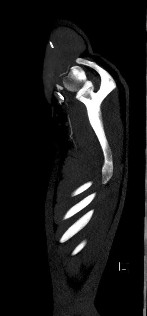Brachiocephalic trunk pseudoaneurysm (Radiopaedia 70978-81191 C 3).jpg