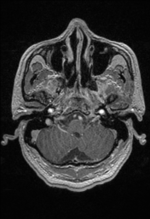 Brain abscess with ventriculitis (Radiopaedia 85703-101495 Axial T1 C+ 37).jpg