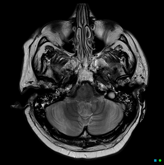 File:Brain death on MRI and CT angiography (Radiopaedia 42560-45689 Axial T2 8).jpg