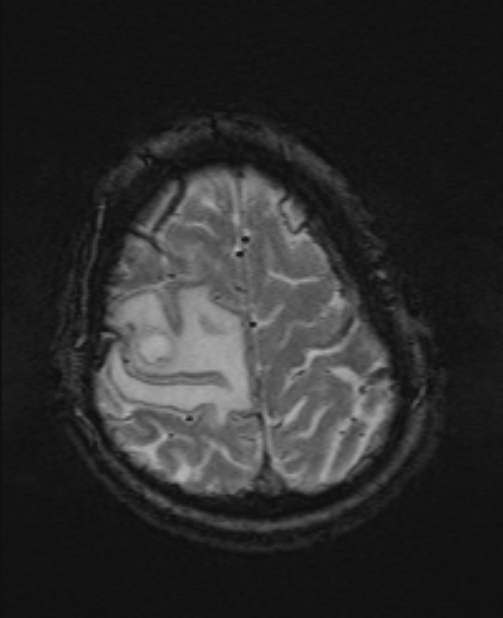 Brain metastases - lung cancer primary (Radiopaedia 75060-86115 Axial SWI 52).jpg