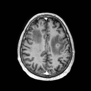 Brain metastases from lung cancer (Radiopaedia 83839-99028 Axial T1 C+ 47).jpg
