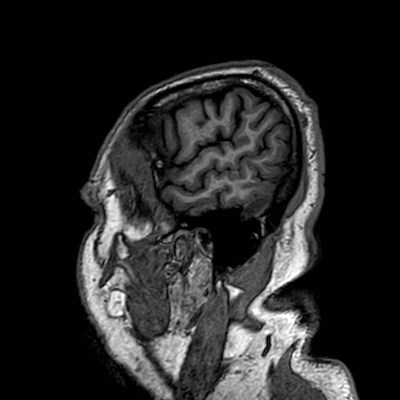 Brain metastases from lung cancer (Radiopaedia 83839-99028 Sagittal T1 11).jpg