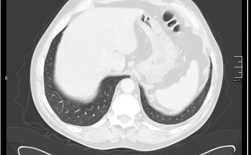 Brain metastases from squamocellular lung cancer (Radiopaedia 56515-63219 Axial lung window 56).jpg