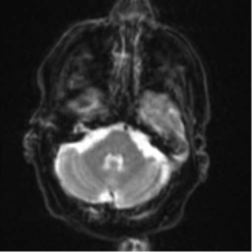 File:Brain metastasis (lung cancer) (Radiopaedia 48289-53179 Axial DWI 6).png