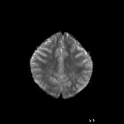 File:Brainstem ganglioglioma (Radiopaedia 10763-11224 Axial DWI 6).jpg