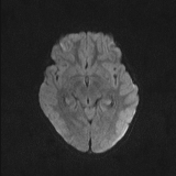 Brainstem glioma (Radiopaedia 67531-76922 Axial DWI 35).jpg