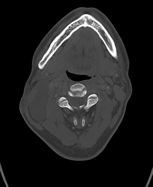 Branchial cleft cyst (Radiopaedia 31167-31875 Axial bone window 29).jpg