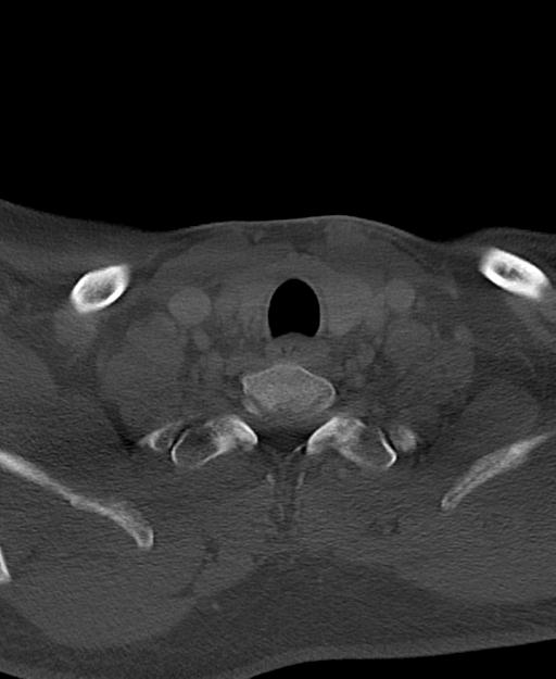 Branchial cleft cyst (Radiopaedia 31167-31875 Axial bone window 63).jpg