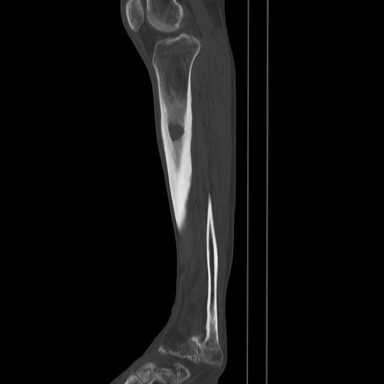 Brodie abscess - tibia (Radiopaedia 66028-75204 Sagittal bone window 45).jpg