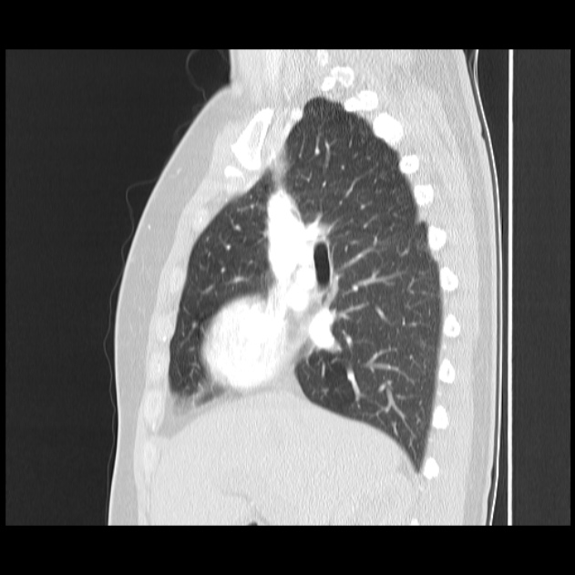 Bronchial atresia (Radiopaedia 22965-22992 Sagittal lung window 34).jpg