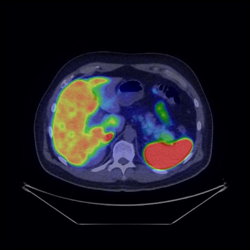 Bronchial carcinoid tumor (Radiopaedia 67377-76765 68Ga-DOTATATE PET-CT 42).jpg