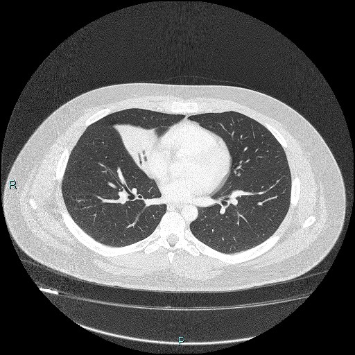 Bronchial carcinoid tumor (Radiopaedia 78272-90875 Axial lung window 28).jpg