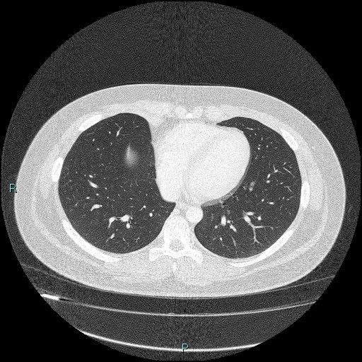 Bronchial carcinoid tumor (Radiopaedia 78272-90875 Axial lung window 35).jpg