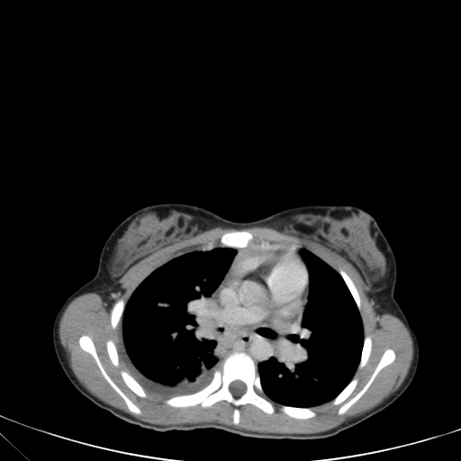 Bronchial mucoepidermoid carcinoma (Radiopaedia 57023-63895 Axial 47).jpg