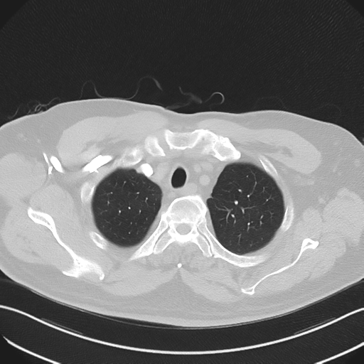 File:Bronchiectasis (Radiopaedia 39385-41666 Axial lung window 13).png