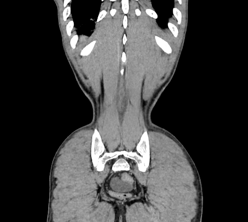 Bronchiectasis in Crohn disease (Radiopaedia 60311-67977 C 80).jpg