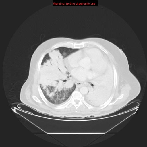 File:Bronchioloalveolar carcinoma (Radiopaedia 9272-9955 Axial lung window 17).jpg