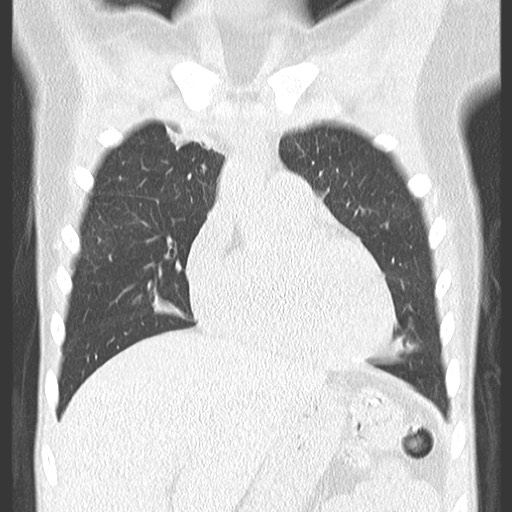 File:Bronchiolotis obliterans (Radiopaedia 73769-84575 Coronal lung window 13).jpg