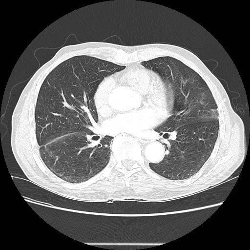 Bronchocele (Radiopaedia 17097-16795 Axial lung window 68).jpg