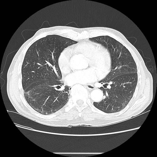 File:Bronchocele (Radiopaedia 17097-16795 Axial lung window 70).jpg
