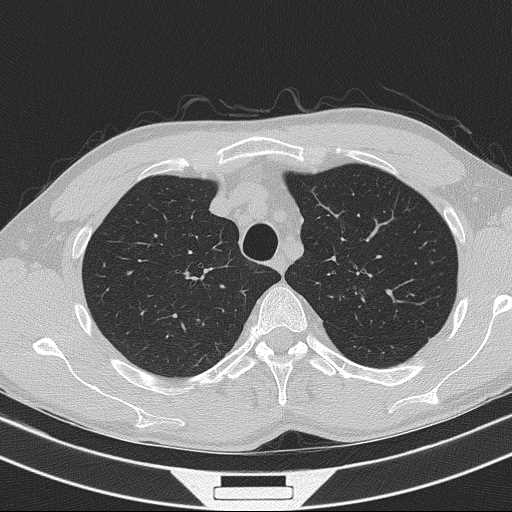 Bronchocele (Radiopaedia 60676-68429 Axial lung window 16).jpg