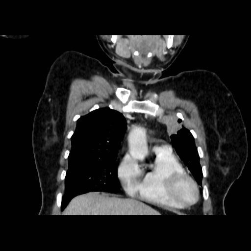 Bronchogenic carcinoma (Radiopaedia 73497-84262 C 42).jpg