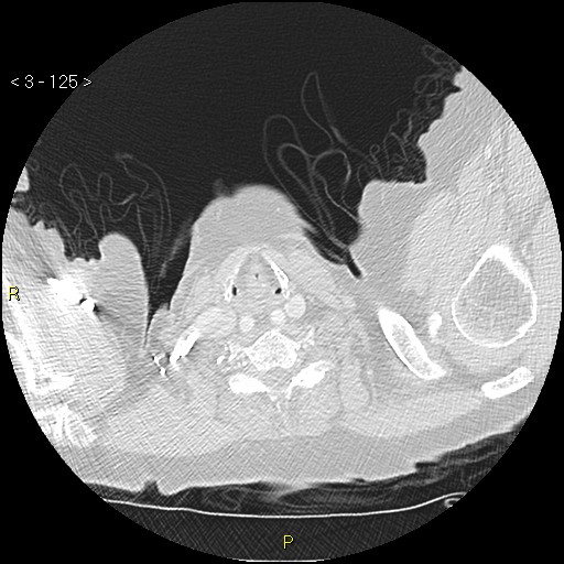 Bronchogenic carcinoma as an incidental finding (Radiopaedia 16453-16130 Axial lung window 125).jpg
