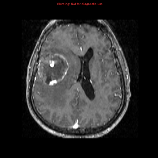 File:Bronchogenic carcinoma brain metastasis (Radiopaedia 9286-9969 Axial T1 C+ 10).jpg
