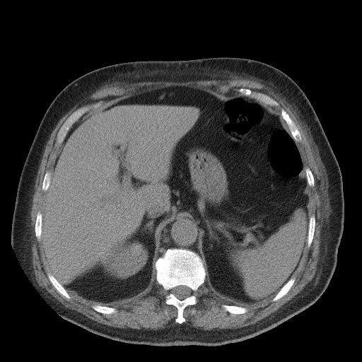 Bronchogenic carcinoma with metastatic lymphadenopathy (Radiopaedia 37671-39569 Axial non-contrast 53).jpg