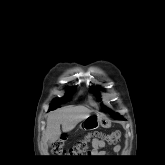 Bronchogenic carcinoma with upper lobe collapse (Radiopaedia 29297-29726 D 9).jpg