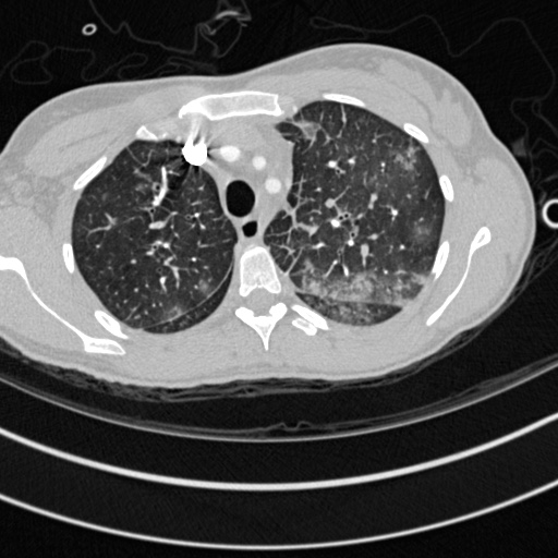 Bronchogenic cyst (Radiopaedia 77801-90071 Axial lung window 10).jpg