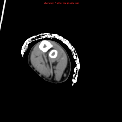 Brown tumor (Radiopaedia 12460-12694 Axial non-contrast 121).jpg