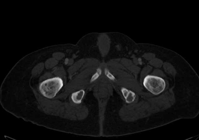 Brown tumors compressing the spinal cord (Radiopaedia 68442-77988 G 135).jpg