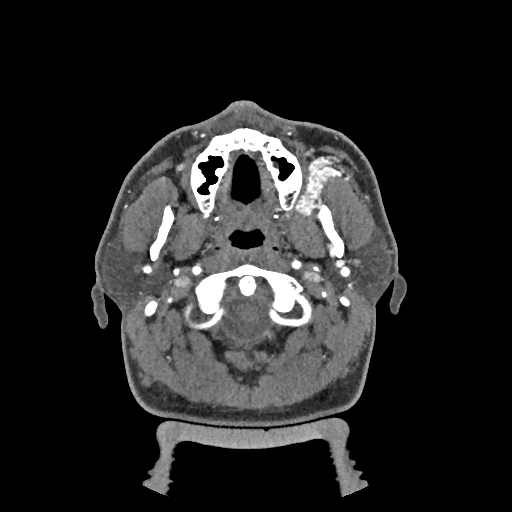 Buccal fat pad arteriovenous malformation (Radiopaedia 70936-81144 D 215).jpg