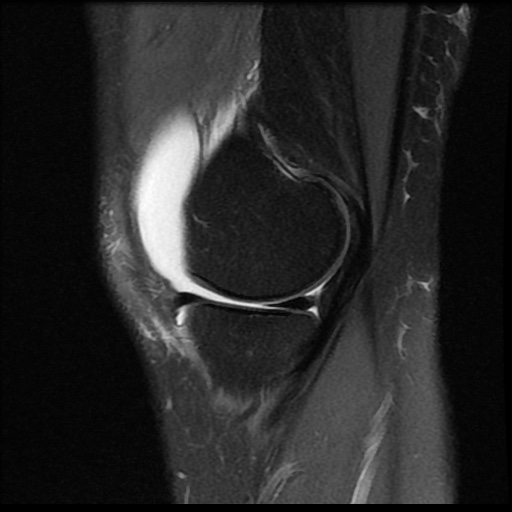 File:Bucket handle meniscus tear (Radiopaedia 56916-63751 Sagittal PD fat sat 15).jpg