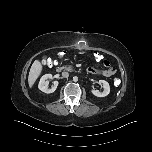 Buried bumper syndrome - gastrostomy tube (Radiopaedia 63843-72575 A 30).jpg