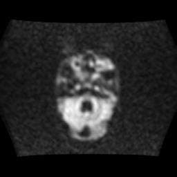 File:Burkitt lymphoma of the orbit- pre and post chemotherapy (Radiopaedia 31214-31929 Axial DWI 3).jpg