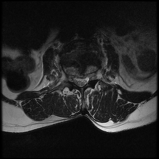 File:Burst fracture - lumbar spine (Radiopaedia 72877-83541 Axial T2 10).jpg