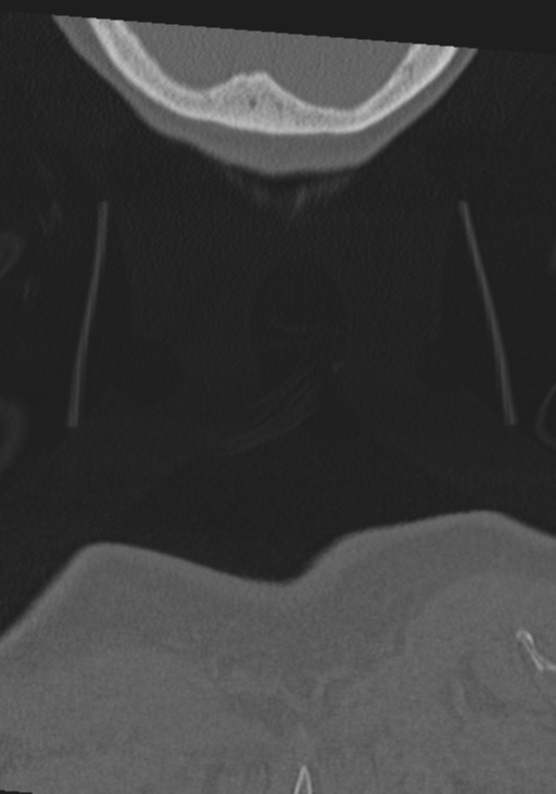 C2 fracture with vertebral artery dissection (Radiopaedia 37378-39199 Coronal bone window 74).png