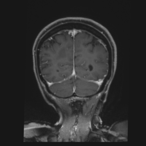 CNS lymphoma with steroid response (Radiopaedia 37980-39921 Coronal T1 C+ 40).png