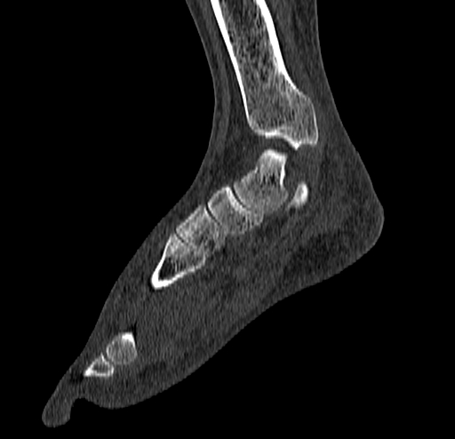 Calcaneal fracture - Sanders type 4 (Radiopaedia 90179-107370 Sagittal bone window 38).jpg
