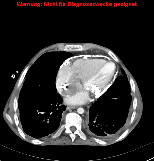 File:Calcific constrictive pericarditis (Radiopaedia 24701-24967 A 21).jpg