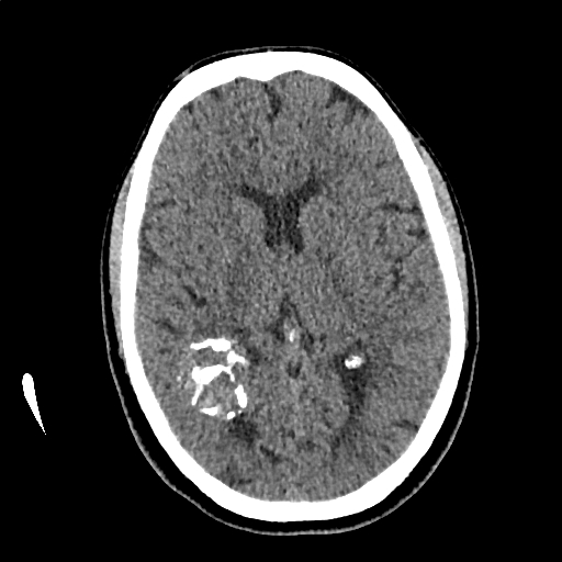 Calcified cerebral hydatid cyst (Radiopaedia 65603-74717 Axial non-contrast 38).jpg