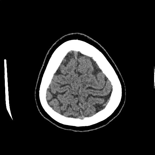 Calcified cerebral hydatid cyst (Radiopaedia 65603-74717 Axial non-contrast 71).jpg
