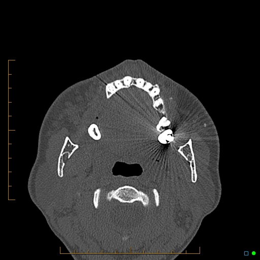 Calcified facial augmentation fillers (Radiopaedia 79514-92679 Axial bone window 88).jpg