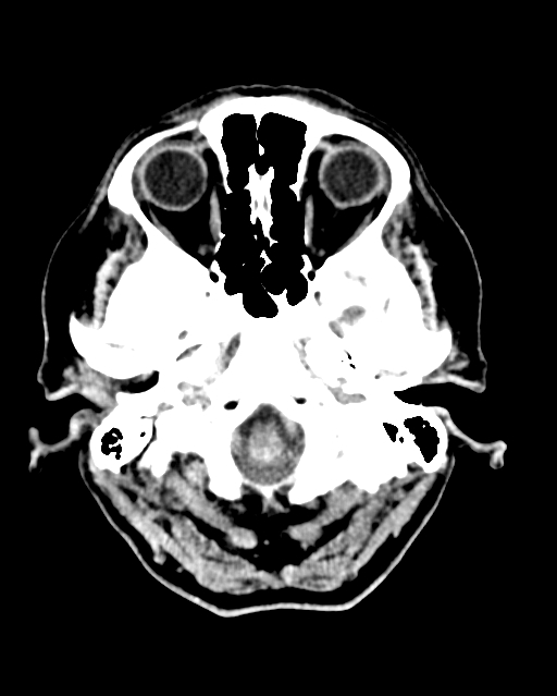 Calcified meningioma (Radiopaedia 74361-85243 Axial non-contrast 45).jpg