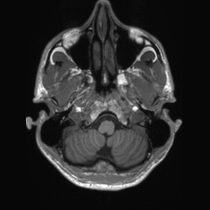 Callosal dysgenesis with interhemispheric cyst (Radiopaedia 53355-59335 Axial T1 21).jpg