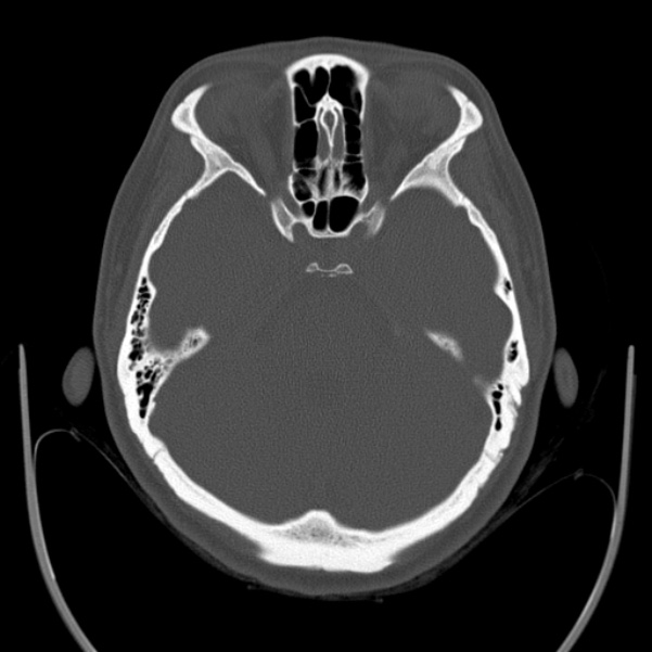 Calvarial osteoma (Radiopaedia 36520-38079 Axial bone window 34).jpg
