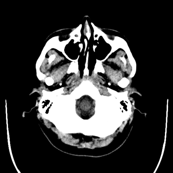 Calvarial osteoma (Radiopaedia 36520-38079 Axial non-contrast 7).jpg
